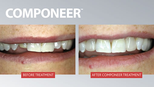 Before and after Componeer Treatment