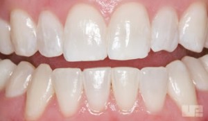 Bleaching After