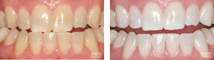 Bleaching Before and After