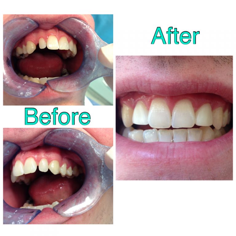 Acorn Dental Dentist in York Composite Build Ups
