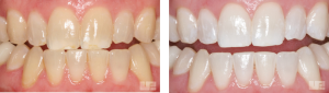 Before and After Teeth Bleaching - Acorn Dental Practice